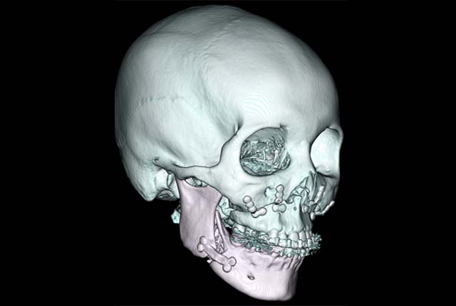 ル・フォー骨切りなどの難易度の高い顎矯正手術（OGS）に対応