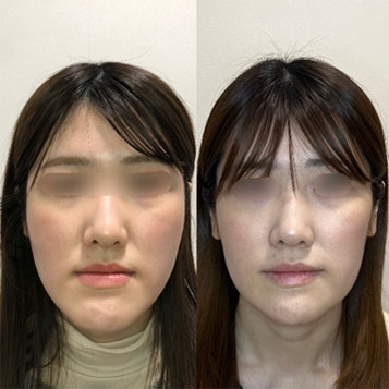 Before After