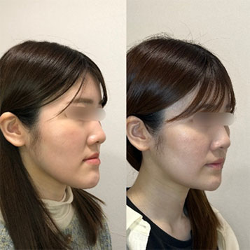 Before After