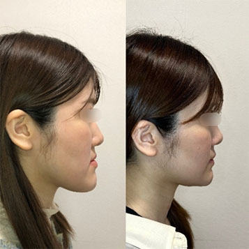 Before After