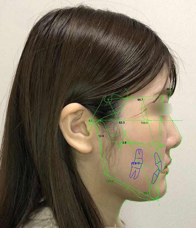 術後シミュレーション