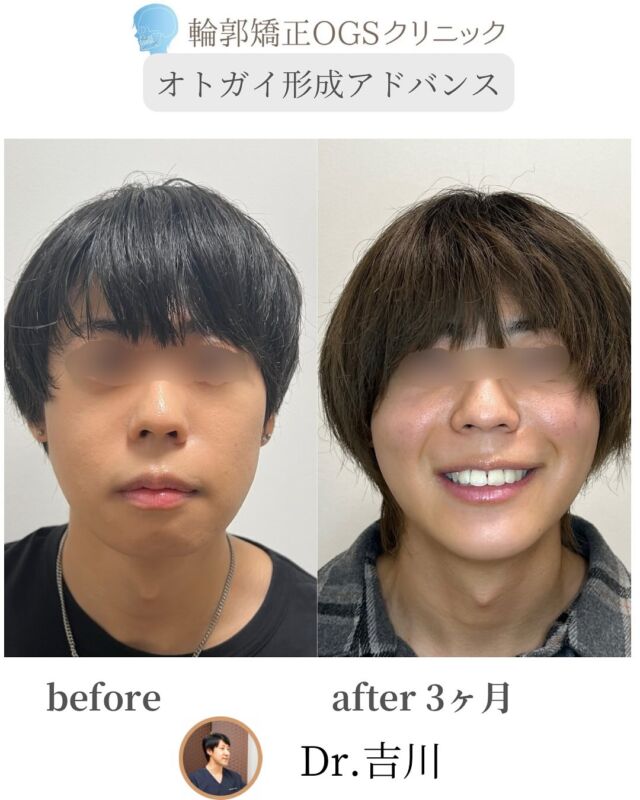 OGSのオトガイ形成アドバンス（骨切り）で、ヒアルロン酸から卒業しよう❗️
⁡
「アゴの形を整えたいけど、ヒアルロン酸の注入を続けるのが大変…」
そんな方におすすめなのが、OGSのオトガイ形成アドバンスです。
⁡
オトガイ形成術アドバンスとは？
⁡
ヒアルロン酸注入は手軽ですが、定期的なメンテナンスが必要で、思ったような立体感が出にくいことも。
繰り返し注入するより、思い切って手術で根本的に改善する方が、実はコスパもタイパも良いんです！
⁡
施術内容
•	オトガイ形成術アドバンス（骨切り＋立体的なデザイン形成）
担当医：吉川秀明（院長）
⁡
こんな方におすすめ！
⁡
✔️ ヒアルロン酸注入を繰り返しているけど満足できない
✔️ 自然な立体感のあるアゴを手に入れたい
✔️ 長期的なコストを抑えたい
⁡
オトガイ形成術アドバンスのメリット
⁡
✨ 自然な立体感が持続
✨ メンテナンス不要でコスパ◎
✨ 顔全体のバランスが整い、横顔も美しく
⁡
手術のリスクについて
•	オトガイ周辺の感覚が一時的に鈍くなる場合がありますが、多くは時間の経過とともに改善します。
•	効果やリスクは症例ごとに異なるため、まずはお気軽にカウンセリングでご相談ください。
⁡
迷っている方へ
⁡
「手術は怖い…」「本当に変わるのかな…」
そんな不安は、誰もが抱えるものです。
⁡
でも、勇気を出して一歩踏み出した先には、理想の自分が待っています。
OGSクリニックでカウンセリングを受けてみてください！そんなあなたを全力でサポートします！
⁡
📍 輪郭矯正OGSクリニック
埼玉県川越市脇田町103番 メディカルセンター川越2F
📞 049-226-1515
🌐 ogs-clinic.jp
X（旧Twitter）: @OGSclinic
YouTubeも更新中！ハイライトからチェック！
⁡
#オトガイ形成 #アゴ整形 #ヒアルロン酸卒業 #アゴが小さい#輪郭矯正 #外科矯正 #骨切り手術 #サージェリーファースト #顎矯正手術 #OGSクリニック #SSRO #美容整形 #顎変形症