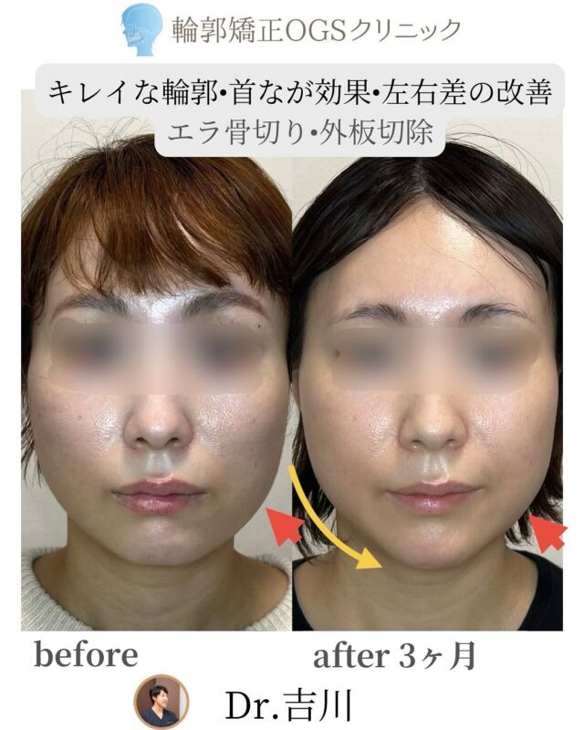 「エラが大きい…」「輪郭の左右差が気になる…」
そんなお悩み、ありませんか？
⁡
脂肪吸引や糸リフトをしても思うような変化が出ない…。
その原因、実は“骨の左右差”かもしれません。
⁡
💡根本改善には「骨切り手術」が有効です！
⁡
今回の患者様は、
・エラの張り
・輪郭の左右差　赤矢印部分を修正骨切りしました
・首を長く見せたい（首長効果）
というお悩みから、「エラ骨切り＋外板切除」を選択されました。
⁡
【🔍 手術の流れ】
CTデータをもとに3Dモデルを作成し、
専用のソフトで骨格の左右差を分析。
その情報をもとに、精密な“サージカルガイド”を作成して安全かつ正確に骨切りを行います。
⁡
当院では、患者様一人ひとりの骨格に合わせたオーダーメイドの手術で、
長年のお悩みを根本から解決し、理想のフェイスラインを目指します✨
⁡
【📸 Before & After】
✔ エラがすっきりしてフェイスラインがシャープに！
✔ 首元もすっきりして、首が長く見える✨
✔ 左右差のない、バランスの整ったお顔に😊
⁡
【🗣患者様の声】
・洗顔のとき、エラに手が当たらなくなった！
・左右差がなくなってコンプレックスが解消✨
・OGSクリニックは先生もスタッフも本当に親身で安心でした！
⁡
【⛑ 手術は安全第一】
麻酔科専門医が常駐する提携病院にて、全身麻酔で行います。
術後は入院でしっかりとケア。安全・安心な環境で受けられます。
⁡
【⚠️ リスク・副作用】
・下唇の感覚の一時的な鈍さ（動きに影響はありません）
・腫れや痛み、感染などの可能性もあります。
⁡
「興味はあるけど、ちょっと怖い…」
そんな方も、どうぞご安心ください。
機能も美しさも大切にするOGSクリニックが、あなたの理想をしっかりサポートします！
⁡
📍 輪郭矯正OGSクリニック
埼玉県川越市脇田町103番 メディカルセンター川越2F
📞 049-226-1515
🌐 ogs-clinic.jp
X（旧Twitter）: @OGSclinic
YouTubeも更新中！ハイライトからチェック！
⁡
#エラ張り解消 #輪郭矯正 #左右差改善 #首長効果 #小顔整形 #エラ骨切り #外板切除 #輪郭形成 #美容整形 #フェイスライン整形 #小顔になりたい #骨切り手術 #OGSクリニック