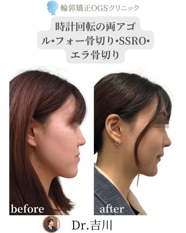 劇的変化を叶える、両顎手術（OGS）✨
⁡
「面長」「受け口」「ガミースマイル」「歯並びの悩み」…これら全てを同時に、根本から解決したいなら、
ル•フォー骨切り＋SSRO（両アゴ）、いわゆる両顎手術（OGS）しかありません。
⁡
💡なぜ、両顎手術（OGS）が選ばれるのか？
⁡
それは、見た目と機能の両方を本質的に変えられるから。
⁡
以下のような変化が実現できます：
⁡
🔹 中顔面短縮：面長＆ガミースマイルを同時に改善。顔の黄金比を整えます。
🔹 上顎の時計回転：横顔に自然なEラインを作り、洗練された印象に。
🔹 受け口改善（SSRO）＋矯正：噛み合わせを正しく、フェイスラインもすっきり。
🔹 エラ骨切り：横顔のキレイと輪郭の美しさを両立させます。
🔹 歯科矯正：キレイな歯ならびと機能的な噛み合わせを実現します。
⁡
これにより、見た目の美しさだけでなく、機能面も改善し、あなたの抱える長年のコンプレックスを解消します。
⁡
✅当院が選ばれる理由
💡両顎手術は、術者の高度な技術と豊富な経験が不可欠です。特に、ル•フォー骨切りまで実施でき、さらに「時計回転」「短縮」といった複雑な操作を正確に行える術者は限られています。
⁡
💡院長の吉川は、大学病院などで顎変形症、腫瘍切除後の顔面再建、顔面多発骨折といった、極めて難易度の高い症例を数多く経験してきました。そのため、機能性と審美性の両方を追求した、あなたの理想を叶える輪郭手術を提供できると確信しています。
⁡
💡術後も安心の入院サポート
当院は、提携医療施設と連携しており、手術後も安心してゆっくり回復できる環境を整えています。
⁡
「ビジネスホテルで過ごすのは不安…」
「海外での手術だと、言葉が通じなくて怖い…」
⁡
そんな心配は一切不要です。
さらに、日本麻酔科学会認定の麻酔科専門医が全身麻酔を担当し、安全性にも万全を期しています。
両アゴ手術の場合は、「4泊5日」を推奨しています。
⁡
🫧「怖い」「不安」…それは当然の感情です
失敗できない、大事な決断になるからこそ、丁寧なカウンセリングに力を入れています。
ご希望・不安・疑問点を一つずつ丁寧に確認し、安心して手術に臨んでいただけるよう全力でサポートします。
⁡
🫶 あなたの「変わりたい」を支えます。
⁡
まずは、あなたが抱えるお悩みや理想について、お気軽にご相談ください。
⁡
ご予約は、🔗リンクをクリックして、ホームページのweb予約で、「骨切りカウンセリング」からご予約が便利です。
⁡
📍 輪郭矯正OGSクリニック
埼玉県川越市脇田町103番 メディカルセンター川越2F
池袋駅から川越駅　　　電車利用　約30分
川越駅からクリニック　徒歩1分
📞 049-226-1515
🌐 ogs-clinic.jp
X（旧Twitter）: @OGSclinic
YouTubeも更新中！ハイライトからチェック！
⁡
#面長 #ガミースマイル#小顔#ガミースマイルを治したい#口元美人 #ル•フォー #SSRO #オトガイ形成 #両顎手術 #輪郭整形 #小顔になりたい #美容整形 #顎変形症 #外科矯正 #サージェリーファースト #OGS#エラ#骨切り#2jaw#両アゴ#両顎