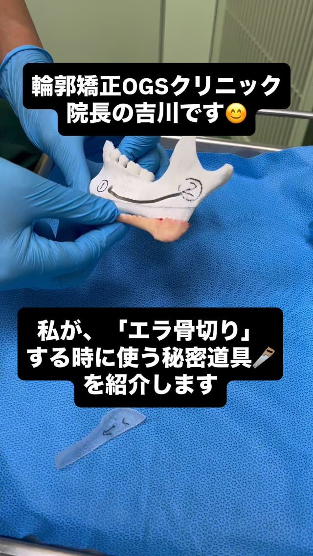 輪郭の手術、エラ骨切りを「正確に」「キレイに」骨切りするのは、とても難しいです。
⁡
私が「正確に」「キレイに」骨切りしている秘密道具をご紹介します。
⁡
【エラ•外板切除の骨切りの効果】
✔ スッキリした輪郭✨
✔ 首元がスッキリして、首長効果
✔ 左右差がなくなり、長年のコンプレックスが解消😊
⁡
脂肪吸引、糸リフトをやっても効果がない。。。
根本的な改善には骨切り手術が最も効果的です。
⁡
麻酔専門医常駐の提携病院で麻酔科専門医による全身麻酔をし、院長の吉川が手術をします。術後も入院してケアを行います。骨切りしたあとに、ビジネスホテルで過ごすのは、不安🫤という事がないようにしています。
⁡
手術リスク
•下口びるの感覚の麻痺（動きの麻痺はないです）
•創部感染
•腫れ
•痛み
などがあります。
⁡
「気になるけど、よく分からないし怖い…」そんな方も大丈夫。輪郭矯正OGSクリニックは、機能も美しさも大切にした輪郭手術で、あなたの理想をサポートします！まずはお気軽にご相談ください。
⁡
📍 輪郭矯正OGSクリニック
埼玉県川越市脇田町103番 メディカルセンター川越2F
📞 049-226-1515
🌐 ogs-clinic.jp
X（旧Twitter）: @OGSclinic
YouTubeも更新中！ハイライトからチェック！
⁡
#エラが大きい  #エラ  #輪郭矯正  #首を長くしたい #麻酔専門医がいる #外板切除  #エラ骨切り  #輪郭形成  #小顔  #美容整形  #輪郭2点  #輪郭3点