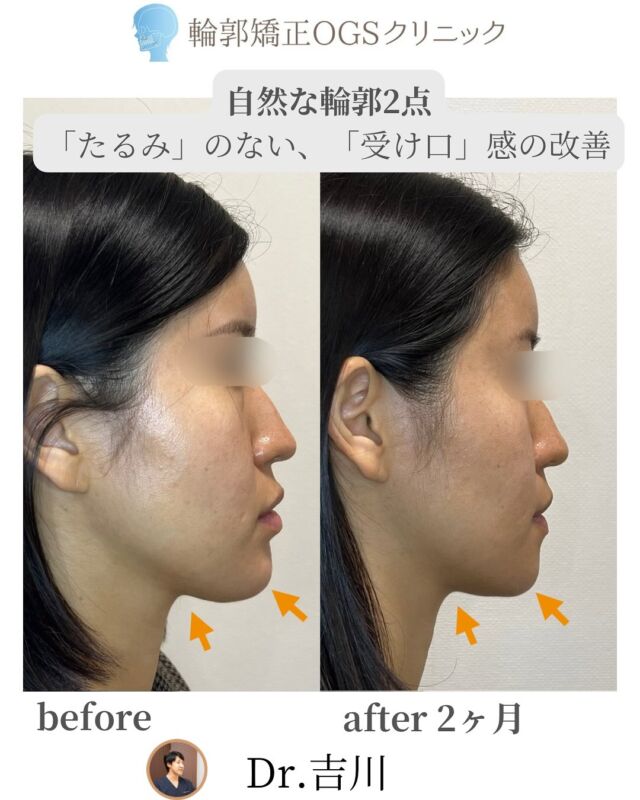 「整形した？」とは思われたくない。
でも、この輪郭、骨切りじゃないと治らない…
自然な変化が叶う「輪郭2点」手術をご紹介します✨
⁡
👤お悩みは…
⁡
・受け口感
・左右差
・面長で長く見える顔
⁡
他院で「両顎手術」をすすめられた方ですが、
💥 ダウンタイム、費用、リスクの負担が大きい…
⁡
そこで当院では、下顎のみの輪郭2点で対応しました！
⁡
✨変化ポイント
⁡
✔ SSROなしでも受け口感が改善
✔ 外板切除で“骨格レベルのダイエット効果”
✔ 左右差が解消され、自然な小顔に😊
⁡
「やせた？」と声をかけられるようになったそうです！
⁡
🏥 安心のサポート
⁡
・麻酔専門医がいる提携病院で全身麻酔
・手術は院長・吉川が担当
・術後は入院対応。ホテル泊なしで安心😌
⁡
まずはカウンセリングで、お悩みをお聞かせください。
自然で美しい輪郭づくり、サポートします✨
⁡
📍 川越 輪郭矯正OGSクリニック
🌐 ogs-clinic.jp｜📞 049-226-1515
🎥 YouTube・Xも更新中！ハイライトからぜひ♪
⁡
#輪郭2点 #骨切り #小顔整形 #自然な整形 #左右差改善
#受け口改善 #エラ骨切り #外板切除 #ダウンタイム少なめ
#麻酔専門医がいる #美容外科 #OGSクリニック
#輪郭3点  #両顎  #ダイエット