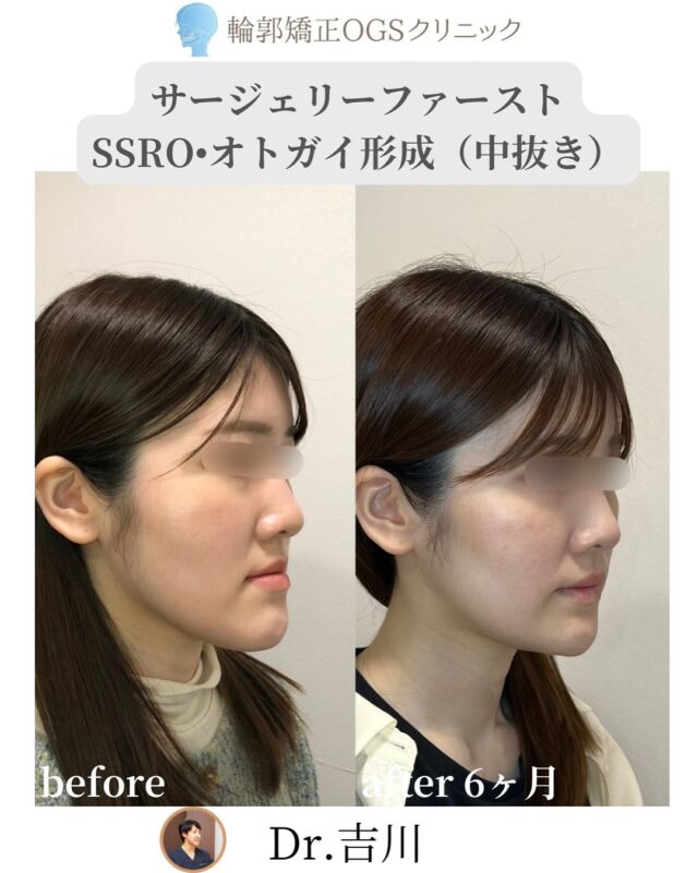「顎変形症を治したい…でも、治療期間が長すぎる」
そんな声を、私はたくさん聞いてきました。
⁡
実際、保険の外科矯正だと5年近くかかることも…
術前の矯正中は、受け口感が目立ってつらいというお悩みも多いです。
⁡
💡そんな方に選ばれているのが
サージェリーファースト（先に手術）
治療期間が半分以下になります
⁡
今回は、SSRO＋オトガイ形成（中抜き）の症例です。
他院のカウンセリングも受けた上で、
「吉川院長が一番親身だった」と、当院を選んでくださいました。
⁡
当初は両顎手術も検討しましたが、
費用やリスク、シミュレーションを踏まえて、
下顎SSRO＋オトガイ形成（中抜き）に。
⁡
🗓術後6ヶ月。
まだ術後矯正中ですが、すでに満足度◎✨
⁡
🔻変化ポイント
✔ 受け口感の改善
✔ 両顎じゃなくても小顔
✔ 圧倒的な治療期間の短縮
⁡
🏥 安心サポート
・麻酔専門医による全身麻酔（提携病院）
・手術は吉川院長が担当
・術後は入院対応。ホテル泊なしで安心😌
⁡
「期間が長いから…」と、あきらめかけていた方へ。
自然で美しい輪郭づくり、全力でサポートします✨
⁡
⚠️手術にともなうリスク
・下唇のしびれ（動きに影響なし）
・腫れ、痛み、感染、左右差など
⁡
📍 川越｜輪郭矯正OGSクリニック
🌐 ogs-clinic.jp｜📞 049-226-1515
🎥 YouTube・Xも更新中！ハイライトからぜひ
⁡
⸻
⁡
#外科矯正 #サージェリーファースト #小顔整形 #受け口 #顎変形症
#骨切り #SSRO #オトガイ形成 #両顎手術 #中抜き
#輪郭整形 #美容外科 #術前矯正 #OGSクリニック  #麻酔専門医#ル•フォー #SSRO #オトガイ形成 #外科矯正 #2jaw
