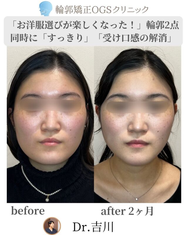 「お気に入りの服を試着したのに、なんかしっくりこない…」
そんな経験、ありませんか？😔
⁡
それ、骨格のバランスが原因かもしれません。
今回は、そんなお悩みに応える、輪郭矯正OGSクリニック　院長吉川による【輪郭2点】手術をご紹介します✨
⁡
👤こんなお悩みに…
・受け口っぽさが気になる
・顔の左右差がある
・顔全体が大きく見えてしまう
⁡
🔄【変化ポイント】
✔ SSROなしでも受け口感がすっきり改善
✔ エラ骨切り＋外板切除で“骨格から”余白カット✂️
✔ 左右差が整い、自然な小顔バランスに😊
⁡
手術後には…
「どんなお洋服も似合うようになって、選ぶのが楽しくなりました！」
と大変喜ばれておりました🎉
⁡
🏥【安心の手術体制】
・麻酔専門医のいる提携病院で全身麻酔対応
・院長・吉川がすべて執刀👨‍⚕️
・術後は入院OK。ホテル泊ナシで安心😊
⁡
⁡
⚠️【手術リスクについて】
・下口唇の感覚の麻痺（動きは問題ありません）
・創部感染
・腫れや痛み などのリスクがあります。
⁡
まずはカウンセリングで、じっくりお話をお聞かせください🪞
“自然で、美しく、自分らしい輪郭”を一緒に目指しましょう✨
⁡
⸻
⁡
📍 川越｜輪郭矯正OGSクリニック
🌐 ogs-clinic.jp｜📞 049-226-1515
🎥 YouTube・Xでも情報発信中！ハイライトからどうぞ✨
⁡
⸻
⁡
#輪郭2点 #骨切り手術 #小顔整形 #自然な整形 #輪郭整形
#受け口改善 #エラ骨切り #左右差解消 #外板切除
#お洋服が似合う顔に #美容外科 #麻酔専門医常駐
 #輪郭矯正OGSクリニック #骨格から変える美しさ