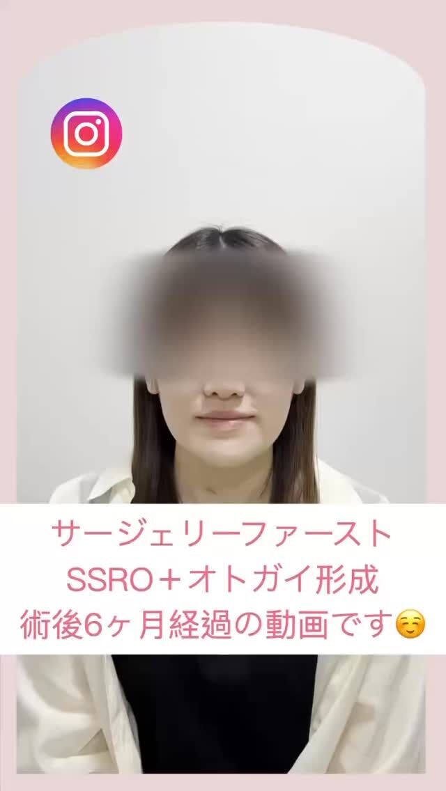輪郭矯正OGSクリニックです🏥
サージェリーファースト法による
外科矯正のSSRO➕オトガイ形成🎥✨患者様ストーリー✨からリアルをお見せします。
👩‍🦰「保険で外科矯正を考えていたけど…
治療には、トータル5年くらいかかる可能性があると言われて、正直時間がかかりすぎる•••そう思ったんです。」
⁡
⏳「時間をそんなにかけられない」
😣「術前矯正で受け口が強調されるのもイヤ」
⁡
👉そこで選んだのが【サージェリーファースト】。
⁡
術後6ヶ月で…
✅矯正の進みが早い！
✅受け口感が強調される期間なし！
😊「やって本当に良かった」と大満足✨
⁡
🏥【安心の手術体制】
・麻酔専門医のいる提携病院で全身麻酔対応
・院長・吉川がすべて執刀👨‍⚕️
・術後は入院OK。ホテル泊ナシで安心😊
⁡
⚠️【手術リスクについて】
・下口唇の感覚の麻痺（動きは問題ありません）
・創部感染
・腫れや痛み などのリスクがあります。
⁡
まずはカウンセリングで、じっくりお話をお聞かせください🪞
“自分にとって、どんな治療が良いのか？を一緒に考えましょう✨
⁡
📍 川越｜輪郭矯正OGSクリニック
🌐 ogs-clinic.jp｜📞 049-226-1515
🎥 YouTube・Xでも情報発信中！ハイライトからどうぞ✨
⁡
#サージェリーファースト
#輪郭矯正 #患者様の声 #外科矯正体験談 #SSRO#輪郭手術 #横顔美人 #コンプレックス解消 #オトガイ形成 #小顔になりたい#麻酔専門医常駐 #輪郭矯正OGSクリニック #外科矯正