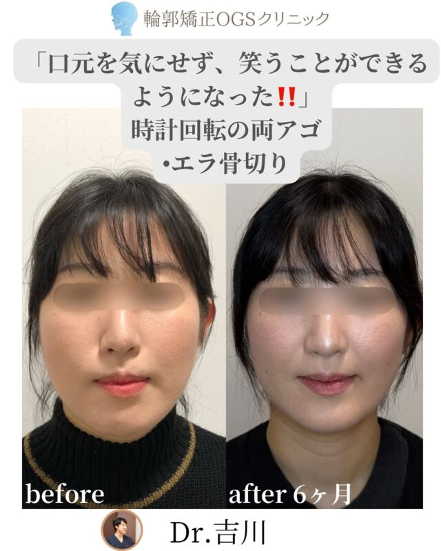 ✨大反響の第二弾✨
💫術後6ヶ月ビフォーアフター💫
⁡
「口ゴボ」と「面長」を同時に治す
💎ル・フォー＋SSRO＋エラ骨切り💎
いわゆる“両顎手術”の術後報告です！
⁡
前回よりもさらに腫れが引き、
フェイスラインがぐっとシャープに✨
より小顔になりました👏
⁡
患者様からは…
😊「口元を気にせず笑えるようになった」
💬「長年のコンプレックスが解消された」
✨「口ゴボと面長で悩んでいる方にオススメ！」
と嬉しいお声をいただいています。
⁡
🏥 安心のサポート体制
・麻酔専門医による全身麻酔（提携病院）
・手術は吉川院長が執刀👨‍⚕️
・術後は入院対応でホテル泊の必要なし😌
⁡
経験豊富な吉川院長が丁寧に対応いたします✨
⁡
⚠️手術にともなうリスク
・下唇のしびれ（動きに影響なし）
・腫れ、痛み、感染、左右差など
⁡
📍川越｜輪郭矯正OGSクリニック
🌐 ogs-clinic.jp
📞 049-226-1515
🎥 YouTube・Xも更新中！
👉ハイライトからぜひチェックしてください💡
⁡
#面長を治したい #時計回転 #小顔整形 #口ゴボ #顎変形症 #骨切り #SSRO #両顎 #エラ骨切り #両アゴ
#輪郭整形 #輪郭矯正 #ガミースマイル #OGSクリニック #面長 #ルフォー #2jaw