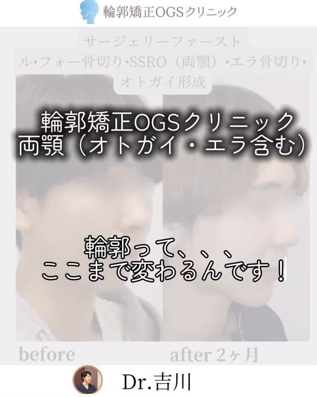 ✨【輪郭矯正OGSクリニック】で、長年のコンプレックスを解消しませんか？✨

「ずっと気になっていた輪郭、変えられるなら変えたい」
そう思いながら、なかなか一歩を踏み出せなかった方へ。

今回ご紹介するのは、ルフォー＋SSRO（両顎手術）、エラ骨切り、オトガイ形成を受けられた患者様の症例です。
術前と術後2ヶ月目の比較写真を見ると、フェイスラインの変化に思わず驚きます…！

🔹 Before → Afterで、輪郭がキュッと引き締まり
🔹 横顔まで美しく、シャープな印象に変化

骨格から整えることで、こんなにも顔全体のバランスが変わるんです✨

「本当に自分も変われるのかな…？」
そんな不安も、当院では経験豊富な院長が丁寧にカウンセリングし、一人ひとりの骨格に合わせて最適な施術をご提案します。

骨格で悩んでいるなら？ぜひ、カウンセリングへお越しください☺️
一緒にお悩みを解決していきましょう。

#輪郭矯正 #小顔になりたい #フェイスライン改善 #骨切り整形 #ルフォー手術 #SSRO #エラ骨切り #オトガイ形成 #美容整形ビフォーアフター #整形で変わる #輪郭整形 #両顎手術 #輪郭矯正OGSクリニック