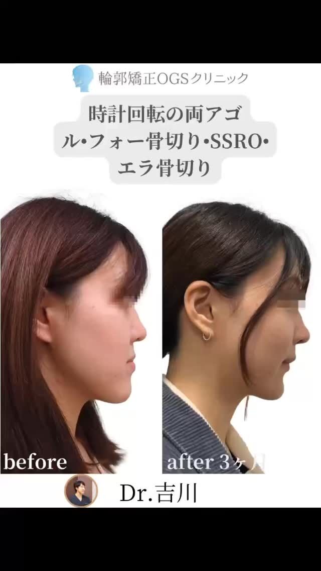 輪郭矯正OGSクリニックです🏥
面長・受け口•ガミースマイルを根本から改善したい方へ。
両顎手術（ルフォー＋SSRO） は、輪郭を劇的に変えることができる治療です。
⁡
中でも、仕上がりを決定づける「時計回転」。
これは、どのドクターでもできるわけではありません。
院長吉川は、大学病院14年以上・外科矯正の専門キャリアから、
この高度な設計を安全に行える“数少ない術者”です👨‍⚕️🔥
⁡
💎 時計回転が生む4つの変化
・面長の解消
・ガミースマイル改善
・受け口感の消失
・顔全体が小さく見える
⁡
🔧 超音波メス×精密な骨切り
ストライカー社の最新“ソノペット”を使用し、
危険な骨切り部位でも神経を温存しながら操作可能。
仕上がりについては、セファロ分析とドルフィンイメージングソフトを用いたビフォーアフターをシミュレーションで、患者様にご提案し、それぞれの好みと医学的な妥当性について分析し、仕上がりを決めていきます。
⁡
🏥 手術体制も万全
・麻酔科専門医が常勤する総合病院で全身麻酔
・すべて院長が執刀
・術後は入院OKで安心感◎
⁡
「実は、ずっといまの輪郭がコンプレックス」
「でも、どう変わるか不安…」
そんな方こそ、一度話を聞きに来てください。
⁡
あなたの“こうなりたい”を叶えるための治療設計を提示します。
⁡
両顎手術は、値段ではなく“仕上がりと安全性”で選ぶ手術です。ぜひ輪郭矯正OGSクリニックで両顎手術を受けてください！
⁡
📍 川越｜輪郭矯正OGSクリニック
🌐 ogs-clinic.jp ｜ 📞 049-226-1515
🎥 YouTube・Xでも症例公開中！ハイライトからチェック👀✨
⁡
#両顎手術 #ルフォー骨切り #SSRO #時計回転 #輪郭矯正
#ガミースマイル改善 #面長改善 #受け口改善 #小顔効果
#骨切り手術 #輪郭整形 #輪郭矯正OGSクリニック #美容外科