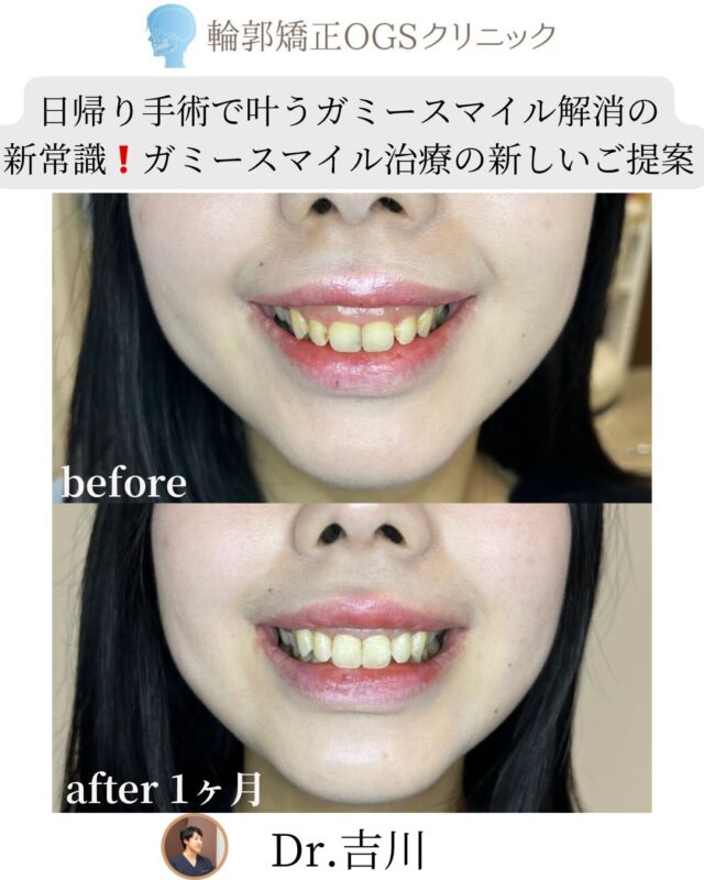 笑うと歯ぐきが出る… ガミースマイル…
それ、骨格が原因かもしれません🧐
⁡
👉ガミースマイルの治療法　　
今回は大きな骨切り手術ではなく
👉《歯肉歯槽骨整形術》という治療をご紹介します。
⁡
🦷 歯肉歯槽骨整形術とは？
⁡
歯ぐきの中にあるゴツゴツ・デコボコした骨をなめらかに整える治療です。
⁡
骨の形を整えることで👇
✔ 笑ったときの見た目が自然に
✔ 歯ぐきが安定しやすい
✔ 術後の「後戻り」が起こりにくい
ガミースマイルが改善します❗️
⁡
⚠️ 実は…
歯肉切除だけの場合、
半年ほどで歯ぐきが元に戻ってしまうことも。
⁡
歯槽骨までしっかり整えることで、
後戻りを防ぎ、効果を長持ちさせることができます。
⁡
🌿 こんな方におすすめ
⁡
✔ 日帰りで治療したい
✔ 1回の施術で改善したい
✔ なるべく痛み・腫れを抑えたい
✔ 効果を長く保ちたい
✔ 歯ぐきの中の骨がゴツゴツしている
✔ ガミースマイルを少しでも改善したい
✔ 矯正までは考えていない／矯正はすでに終了
✔ ルフォー・両顎手術までは不安…
✔ ペットがいて入院できない
⁡
そんな方こそ、ぜひ一度ご相談ください😊
🏥 ガミースマイルを「骨格」から整える専門クリニック
あなたにとっての最善の治療法を
輪郭矯正OGSクリニックで一緒に考えましょう。
⁡
📍 川越｜輪郭矯正OGSクリニック
🌐 ogs-clinic.jp
📞 049-226-1515
🎥 YouTube・Xでも症例公開中！ハイライトからチェック👀✨
⁡
#ガミースマイル
#両顎手術
#笑うと歯茎が出る
#歯茎が見える
#歯肉歯槽骨整形