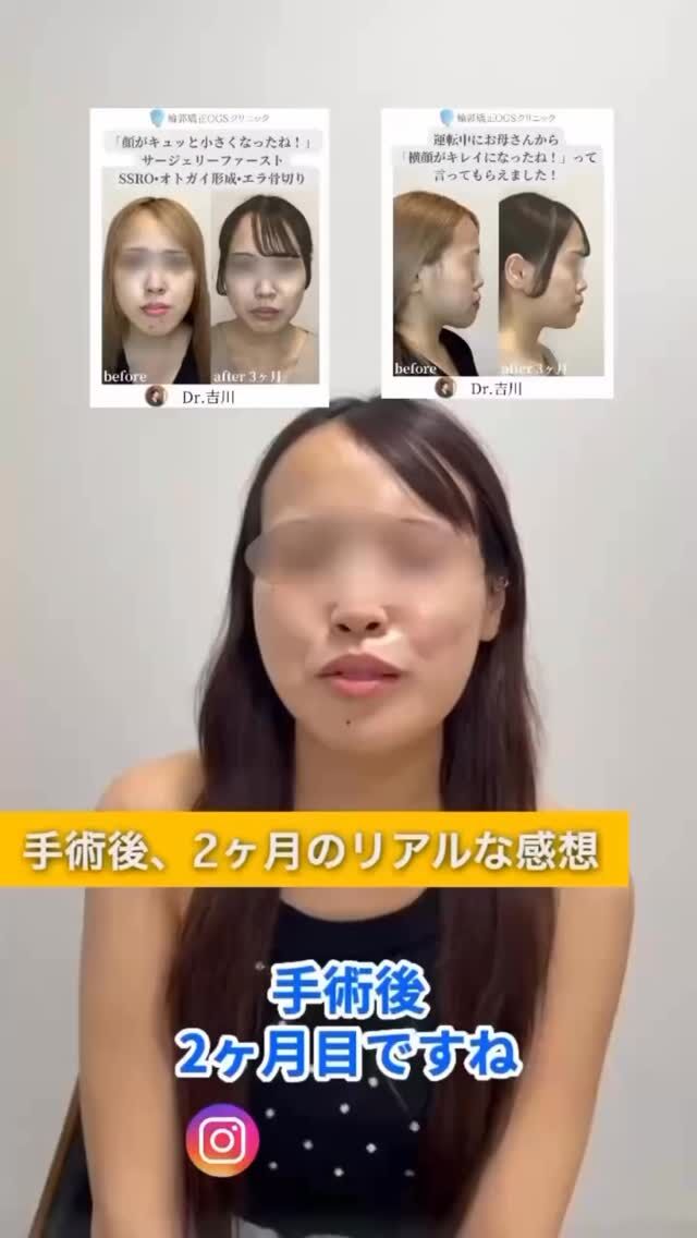 【サージェリーファースト症例】
SSRO＋オトガイ形成
（中抜き＋輪郭左右差修正）
術後2ヶ月・3ヶ月の変化をご紹介します。

手術前は挑戦できなかった
・落ち着いた髪色
・自然なカラーコンタクト
・自分に似合う雰囲気づくり

術後は、
「顔がキュッと小さくなったね」
「横顔がきれいになったね」
そんな声を、ご友人やご家族から言われるように。

輪郭が整うことで、
髪型・メイク・服装まで
前向きに“自分の理想”を楽しめるようになります。

⏱ いきなり変われる
🪞 輪郭の左右差まで整えられる

それが
輪郭矯正OGSクリニックの
サージェリーファースト法です。

「長い矯正期間が不安」
「輪郭も一緒に整えたい」
そんな方は、ぜひ一度ご相談ください。
#サージェリーファースト
#SSRO
#オトガイ形成
#顎変形症
#外科矯正
