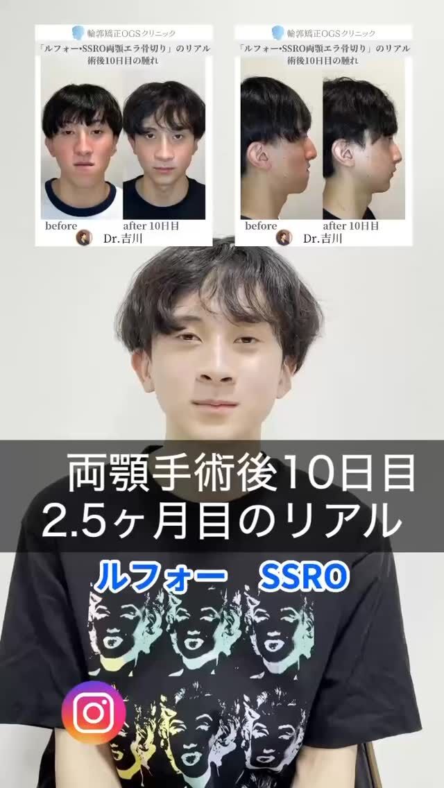 【両顎手術のリアル】
術後10日目 ➡ 2.5ヶ月の経過レポート

ポイントは3つ
✔ 10日目で腫れがかなり少ない
✔ 思ったより痛みが強くなかった
✔ 2.5ヶ月で知覚の違和感がほぼ改善

※ただし個人差があります
腫れの出方・回復スピード・知覚の戻り方は人それぞれ。
今回の症例は回復がとても順調だったケースです。

「実際の術後が知りたい」
そんな方はぜひ保存して参考にしてください。

輪郭矯正OGSクリニックは
手術だけでなく“術後の安心”までサポートします。

#両顎手術
#ルフォーssro 
#術後経過
#ダウンタイム
#SSRO