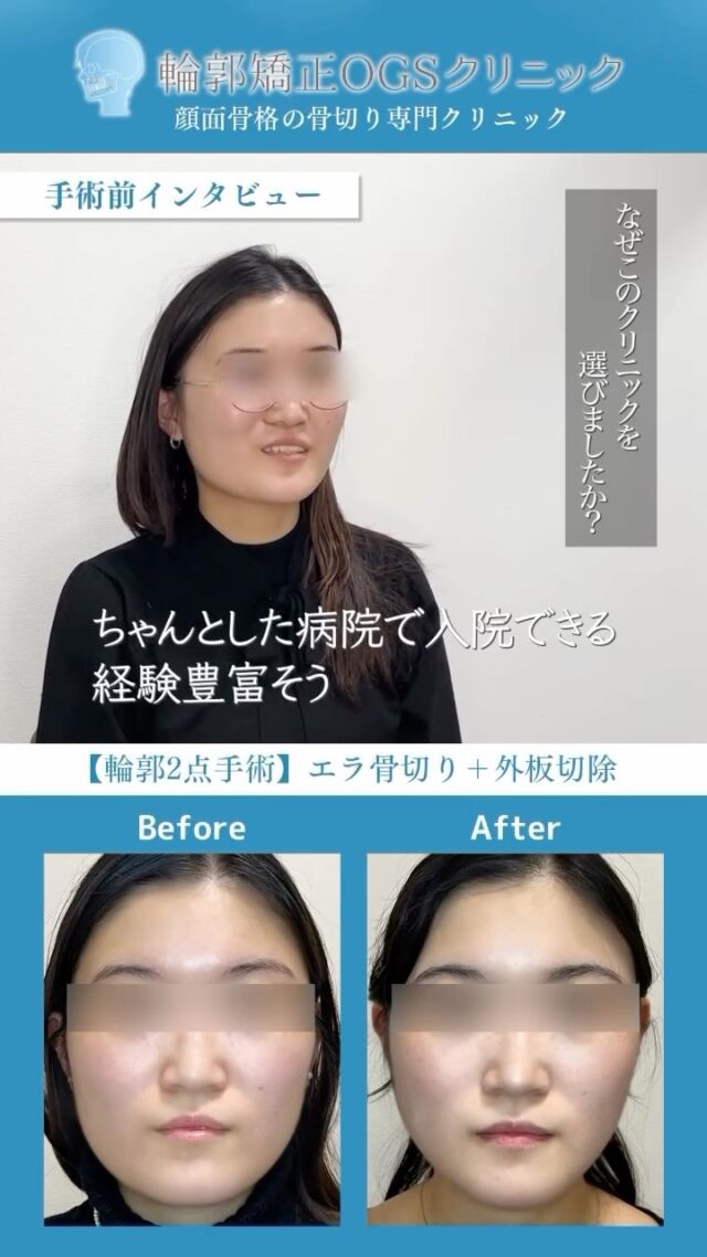 輪郭2点でここまで変わります

今回ご紹介するのは
エラ骨切り＋オトガイ形成（輪郭2点）症例です。

患者様のお悩み
・エラの張り
・フェイスラインの横幅
・顎先のバランス

こちらの症例では
エラ骨切りだけではなく、外板切除も行い、横幅を狭くするようにしています。
下顎下縁もオトガイまで骨切りすることで
フェイスラインを自然にシャープにしています。
Vライン形成とも言われます。

またオトガイ形成では
顎先の長さと前後バランスを調整し
横顔のラインを整えました。

患者様からは
「小顔になったね❗️と言われるようになった😊」
「以前よりもお洋服選び、メイクが楽しくなった❗️」
「写真を撮るのが楽しみになった🍀」
と嬉しいご感想をいただきました。

当院では
CTやセファロ分析を行い
骨格や噛み合わせを確認したうえで
手術計画を立てています。
また、3Dモデルと正確な骨切りをするための骨切りガイド装置を作製しています。
手術は、全身麻酔下で行い、日帰りということはなく、過ごしていただいております。

「輪郭に違和感を感じている」
「輪郭をしっかり整えたい」
というお悩みがある方は
カウンセリングでご相談ください。

#輪郭形成 #エラ骨切り #オトガイ形成 #美容外科 #骨切り