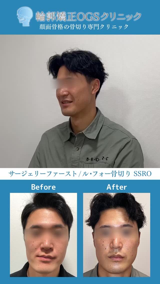 この春に治療が完了しました。患者様をご紹介致します。

「就職に間に合わせたい」
その選択がサージェリーファーストでした。

輪郭矯正OGSクリニックで
サージェリーファースト法を受けていただいた患者様のリアルです。

患者様のお悩み
・左奥歯でしか噛めない
・このままだと将来的に歯への負担が心配
・外科矯正をしたいが、時間の問題がある

保険での外科矯正では
治療期間が長く、大学在学中に終わらない可能性がありました。

「就職先に迷惑をかけられない」
その想いから、治療期間を短縮できる
サージェリーファースト法を選択されました。

当院では
骨格・噛み合わせを分析し、
機能と見た目の両方を考えた治療計画を立てています。

術後は
・奥歯でしっかり噛めるようになった
・ご家族からも「顔のバランスが良くなった」とのお声

「ここで治療してよかった」
そう言っていただける結果となりました。

この春からは
ご希望されていた救命救急の現場で新しいスタートへ。

〇〇さん、ご卒業おめでとうございます🌸
新しい環境でも応援しております✨

#サージェリーファースト #外科矯正 #両顎手術 #骨切り #輪郭形成