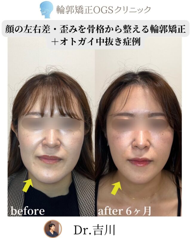 ✨やりすぎない、でも確実に変わる
⁡
今回は
輪郭矯正（左右差補正）＋オトガイ中抜き症例
をご紹介します。
⁡
💭 お悩み
⁡
・あご先の左右差が気になる
・少し受け口っぽい口元
・でも外科矯正まではしたくない…
⁡
そんなご相談でした。
⁡
🛠 行った治療
⁡
・下顎外板切除
・下縁形成
・オトガイ中抜き（時計回転方向）
⁡
※歯科矯正なし
※上下顎の外科矯正なし
⁡
大きく変えるのではなく、
“必要な部分だけ”を整えました。
⁡
🌿 変化
⁡
・左右差が改善
・輪郭がより自然に
・受け口感が目立ちにくく
⁡
やりすぎない。
でも、確実に違和感が減る。
⁡
🦴 骨格の違和感は
必ずしも上下顎手術だけが選択肢ではありません。
⁡
「必要な部分だけ整える」という選択。
⁡
それが
輪郭矯正OGSクリニックの“輪郭矯正”です。
⁡
📍 川越｜輪郭矯正OGSクリニック
🌐 ogs-clinic.jp
📞 049-226-1515
🎥 YouTube・Xでも症例公開中！ハイライトからチェック👀✨
⁡
#骨格から治す
#オトガイ形成
#アゴがずれている
#輪郭矯正
#顔の左右差を治したい