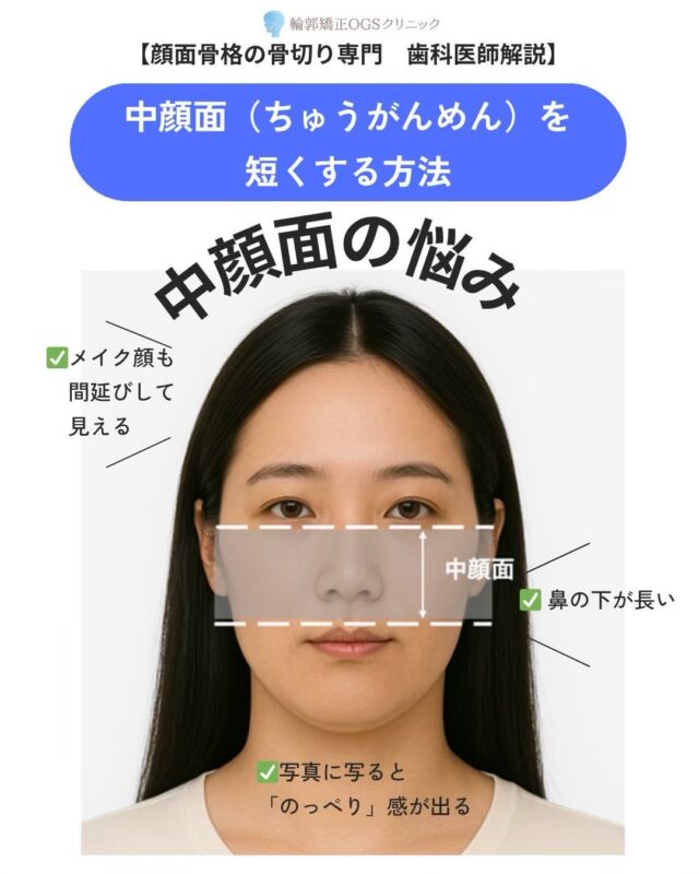 中顔面の長さ、鏡を見るたびに気になっていませんか？😢

「鼻の下が長く見える…」「顔全体が間延びして見える…」「横顔がなんとなく垢抜けない…」

実はこのお悩み、学生さんから社会人、ママさん世代まで、幅広い方が抱えています。

OGSクリニックでは、メイクでできる“見せ方”の工夫から、骨格レベルで改善する「ルフォー骨切り」まで、原因に合わせた治療をご提案しています✨

特に、中顔面の印象は単純に短くすれば良いわけではありません。

・上顎骨の位置・口元の突出感・笑った時の歯茎の見え方・横顔バランス

これらを総合的に分析し、顔全体の調和を考えながら治療設計を行うことが重要です。

また、よくご質問いただく「ダウンタイムは？」「痛みは強い？」といった不安についても、当院では超音波メス（ソノペット）などを使用し、安全性と術後負担の軽減に配慮しています🦷✨

「自分にはどの治療が合うの？」「骨切りまでは必要？」「まずは話だけ聞いてみたい」

そんな方は、ぜひプロフィールリンクの公式サイトをご覧ください💻✨

中顔面のコンプレックスを、“隠したい悩み”から“自信の持てる横顔”へ。

監修：輪郭矯正OGSクリニック院長 吉川秀明

#中顔面短縮 #中顔面 #ルフォー骨切り #ルフォー #両顎手術