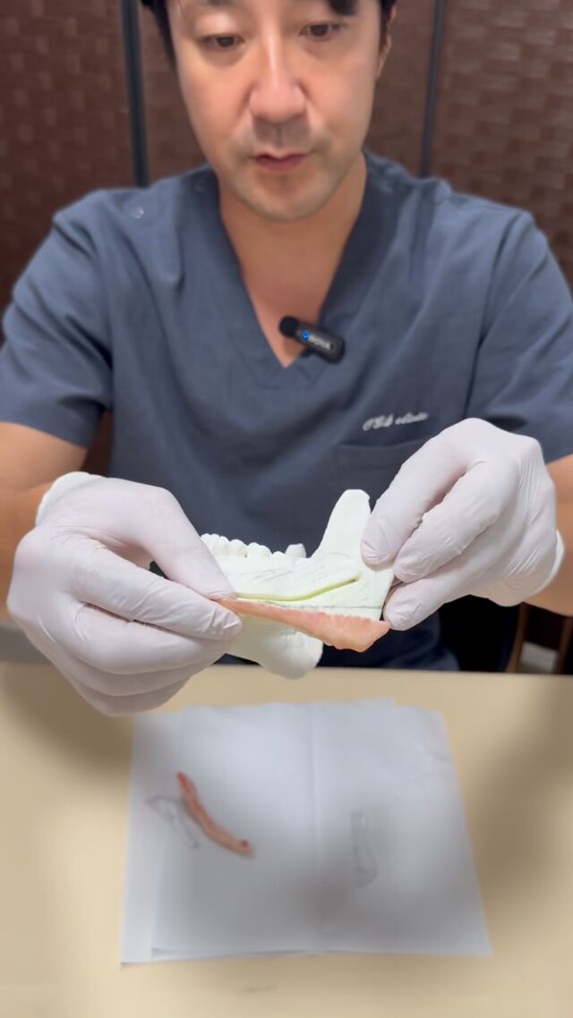 エラ骨切りやVライン形成は、デザインだけが重要ではありません。

患者様の骨格やご希望に合わせて設計したデザインを、実際の手術でどれだけ正確に再現できるかも重要です。

輪郭矯正OGSクリニックでは、CTデータをもとに3Dで骨格を確認し、CAD/CAM技術を用いて3Dサージカルガイドをオーダーメイドで作製しています。

手術ではこのガイドを使用し、事前に計画した骨切りラインをできるだけ正確に再現できるようにしています。

また、エラを小さくすることだけを考えると、下顎のラインが不自然になり、顎先だけが尖って前に出たような、いわゆる「イヌアゴ」のような印象になることがあります。

そのため当院では、エラだけを部分的に見るのではなく、下顎角から下顎下縁、顎先までのラインを一つの連続した輪郭として設計します。

左右の骨格差や下顎の形態を確認しながら、どこからどこまでを、どの角度で整えるのかを事前に計画することで、エラだけが小さくなった不自然な輪郭ではなく、顔全体のバランスが整ったフェイスラインを目指します。

「どこを切るか」だけではなく、「切った後にどんな輪郭になるか」。

その両方を考えて設計し、3Dサージカルガイドによって手術へ正確に落とし込む。

それが、輪郭矯正OGSクリニックが大切にしているエラ骨切りです。
#エラ骨切り #vライン形成 #骨切り